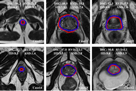 Multiparametric MRI for the Prostate • Quantitative Bioimaging Laboratory