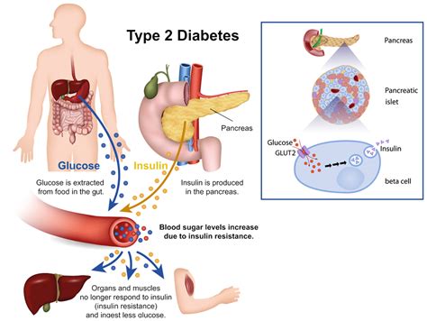 Timely insulin therapy to treat type 2 diabetes - Research Outreach