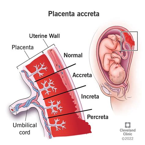 Placenta Accreta: Types, Risks, Causes & Treatment