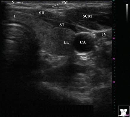 Normal Thyroid Appearance and Anatomic Landmarks in Neck Ultrasound ...