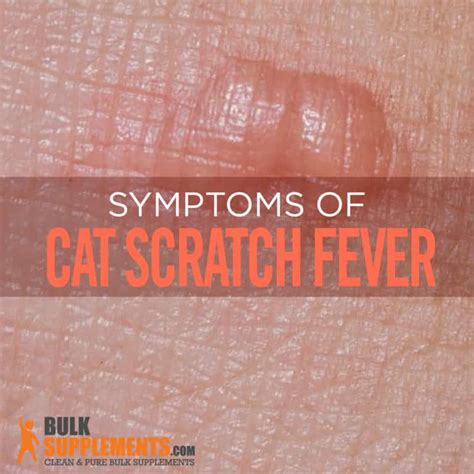 Cat Scratch Fever: Characteristics, Causes & Treatment