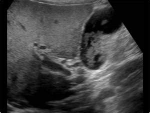 Abdomen and retroperitoneum | 1.2 Gallbladder and bile ducts : Case 1.2 ...