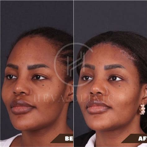 Forehead Reduction Before & After Photos - Unfiltered Results