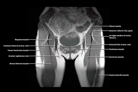 Mri Pelvis Anatomy Free Male Pelvis Axial Anatomy Pelvis Anatomy ...