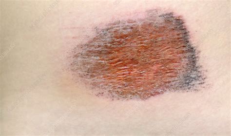 Abrasion of the skin - Stock Image - C015/1605 - Science Photo Library