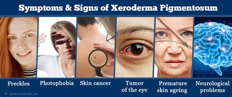 Xeroderma pigmentosum - WikiLectures