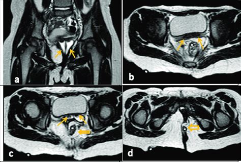 5 years old girl with previously operated cloacal malformation ...