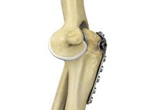 Elbow Fracture Surgery Chicago | Elbow Injury Naperville