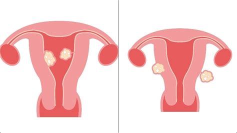 Fibroids: Types, causes, symptoms, risk factors, treatment of myomas by ...