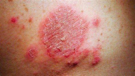 Eczema In Pictures: What Do the Types Look Like?