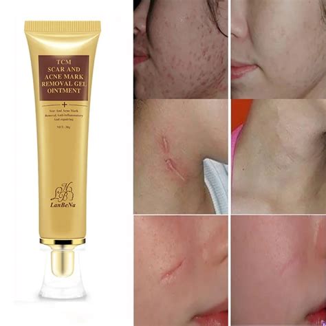 Face Beauty Scar Removal Cream Skin Repair 30ml Face Cream Blemish ...