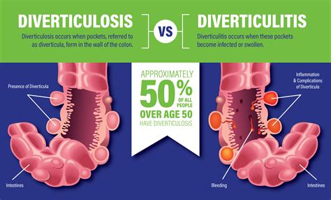 Diverticulitis_VS_Diverticulosis_Blog - Lakeland Surgical & Diagnostic ...