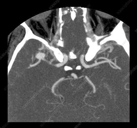 Brain Aneurysm Ct Scan - Diagnosis of a brain aneurysm may require ct ...