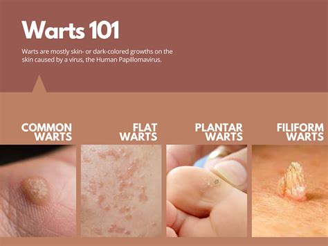 The Derma Corner: The 101 on warts, potential treatments, and how to ...