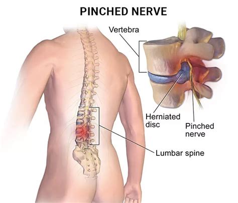 5 Common Symptoms of a Pinched Nerve - NJ's Top Orthopedic Spine & Pain ...