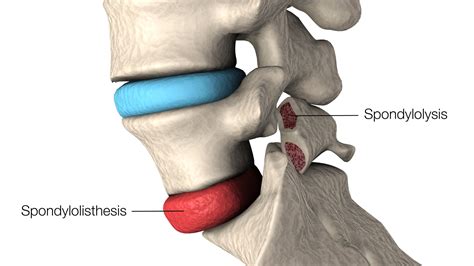 Spondylolisthesis | Medical City Children's Orthopedics & Spine Specialists