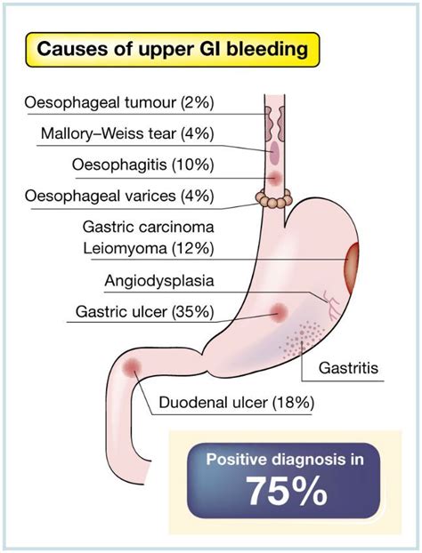 Related image | Ulcers, Gastrointestinal disorders, Gastric carcinoma