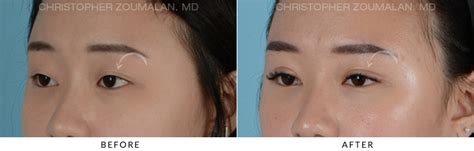 Asian Eyelid (Double Eyelid) Surgery Before and After Photo Gallery