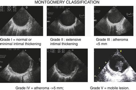 Atherosclerosis Of Aorta Ultrasound