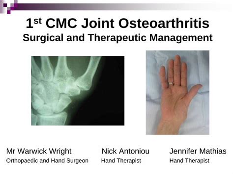 (PDF) 1st CMC Joint Osteoarthritis - Nick Antoniou Hand Therapy ...