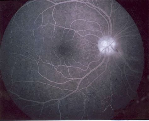 Diagnostics - Retina Specialists Huntington Beach 92647