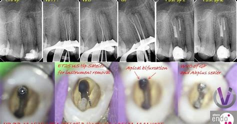 The Root Canal Anatomy Project: Three-Rooted Maxillary Premolar