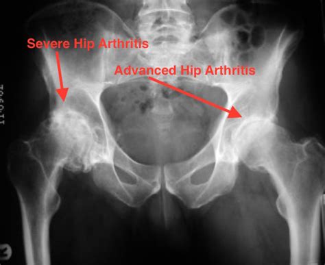 Arthritis – Knee and Hip Website