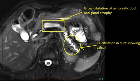 Chronic pancreatitis MRI - wikidoc