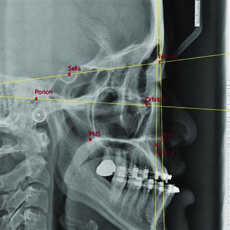 Healing pattern of the intentional fracture site of the pterygoid ...