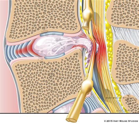 Stages of L4 and L5 vertebral disc herniation