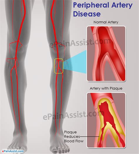 Peripheral Artery Disease|Causes|Symptoms|Treatment|Do’s & Don’ts