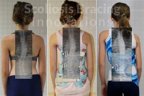 Spinal Braces - Scoliosis Bracing Innovations