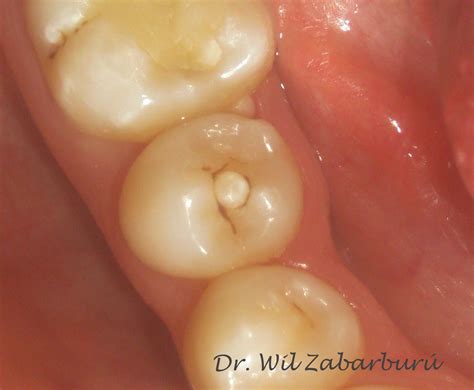 CLINICA DENTAL ASISTENCIAL: PREMOLAR DE LEONG