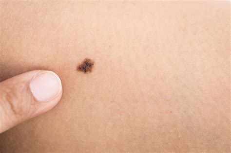 What Are Birthmarks? Types and Treatments | UPMC HealthBeat