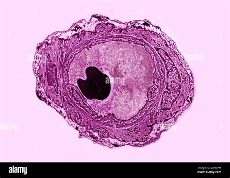 ATHEROMA, HISTOLOGY Stock Photo - Alamy