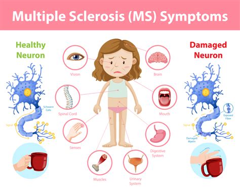 Nursing Care Plans For Multiple Sclerosis With Examples | The Study Corp