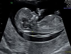 Nuchal Translucency and Nasal Bone Assessments - Level II Ultrasound ...