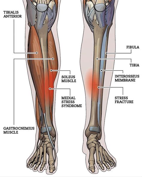 Posterior Shin Splints Bumps