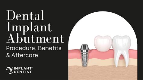 Dental Implant Abutment - Procedure, Benefits & Aftercare