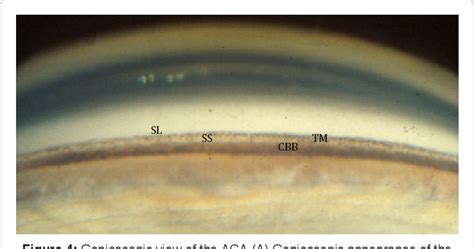 Figure 3 from Angle Closure Glaucoma: Pathogenesis and Evaluation. A ...