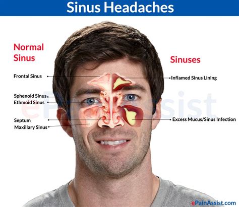 Frontal Sinus Headache