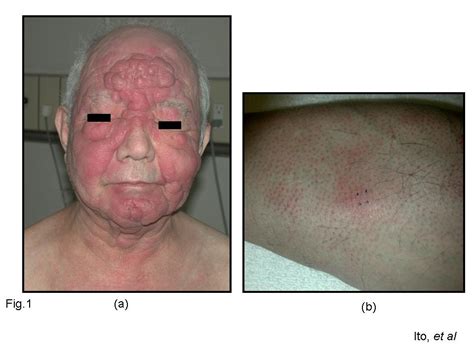 Skin Cancer Mycosis Fungoides