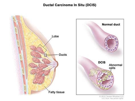 Risk of Breast Cancer Death is Low After DCIS Diagnosis - NCI