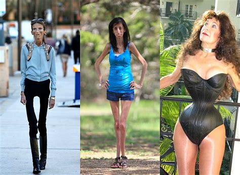 Skinniest Woman In The World – Telegraph