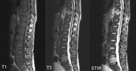 Spinal imaging update | Bone & Joint