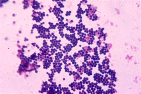 Staphylococcus aureus. Is a type of bacteria. It stains Gram positive ...