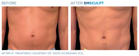 Body Sculpting Treatment: What To Do Before and After A Procedure ...