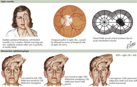 Multiple Sclerosis | Clinical Gate