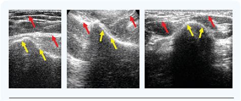 Figure 1 from Ultrasound imaging and segmentation of bone surfaces: A ...