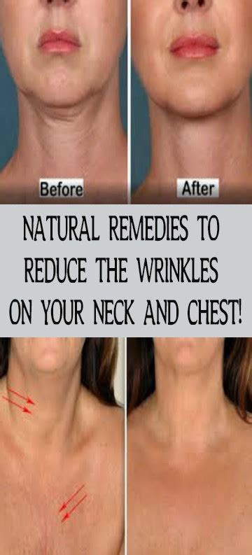 NATURAL REMEDIES TO REDUCE THE WRINKLES ON YOUR NECK AND CHEST!